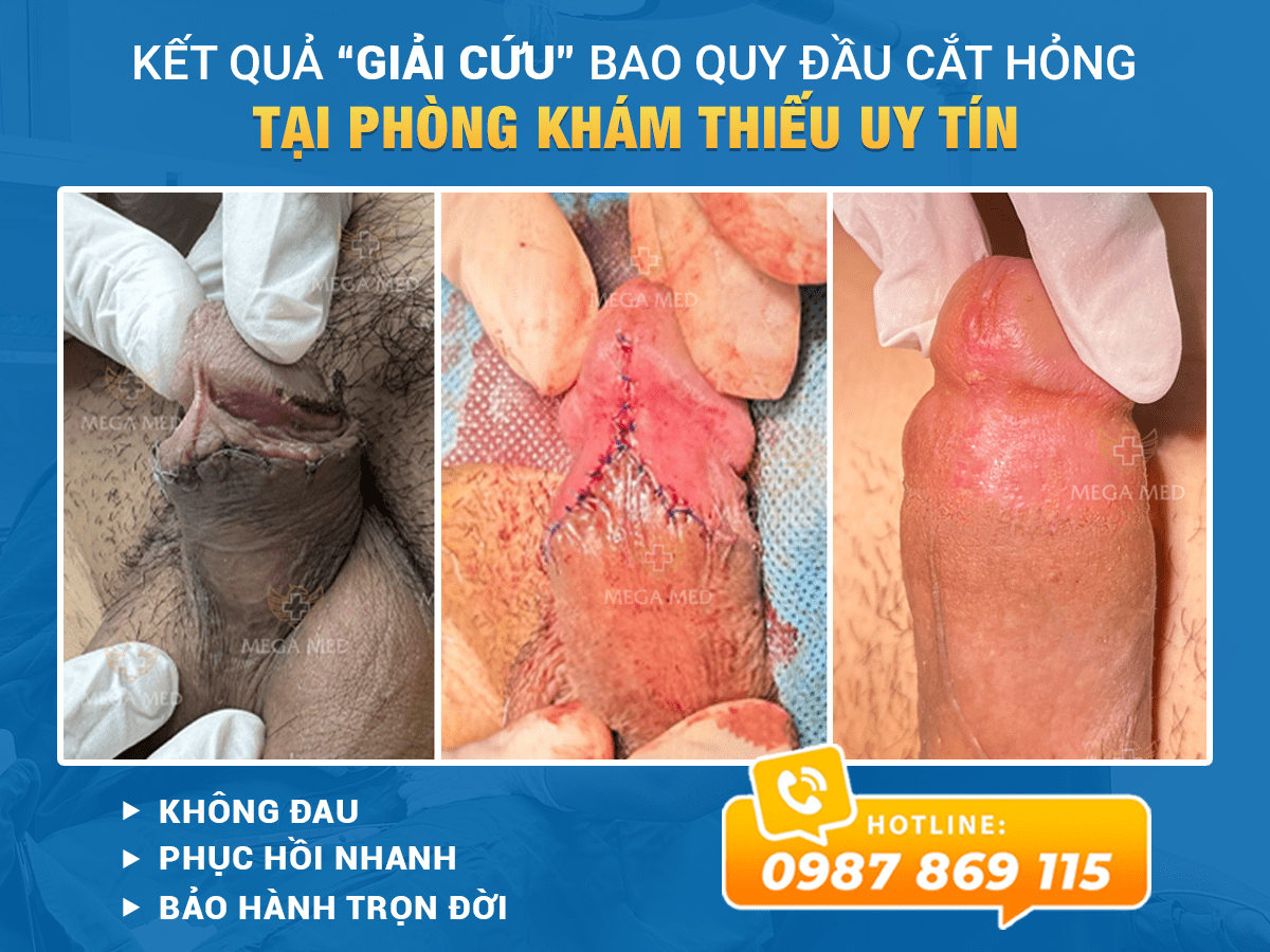Giải cứu bao quy đầu hỏng tại phòng khám thiếu uy tín